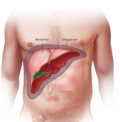 A diagram of a normal liver vs. an enlarged liver